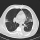 Bronchopneumonia, biopsy, follow-up: CT - Computed tomography